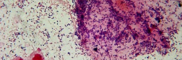 Bacterial Vaginosis 