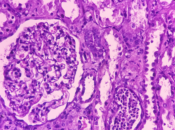 Microscopic tissue image showing cellular changes related to pelvic cancer treatment