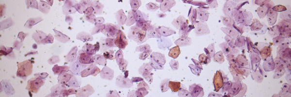 Microscopic image representing urinary tract infections and vaginal microbiome changes during menopause